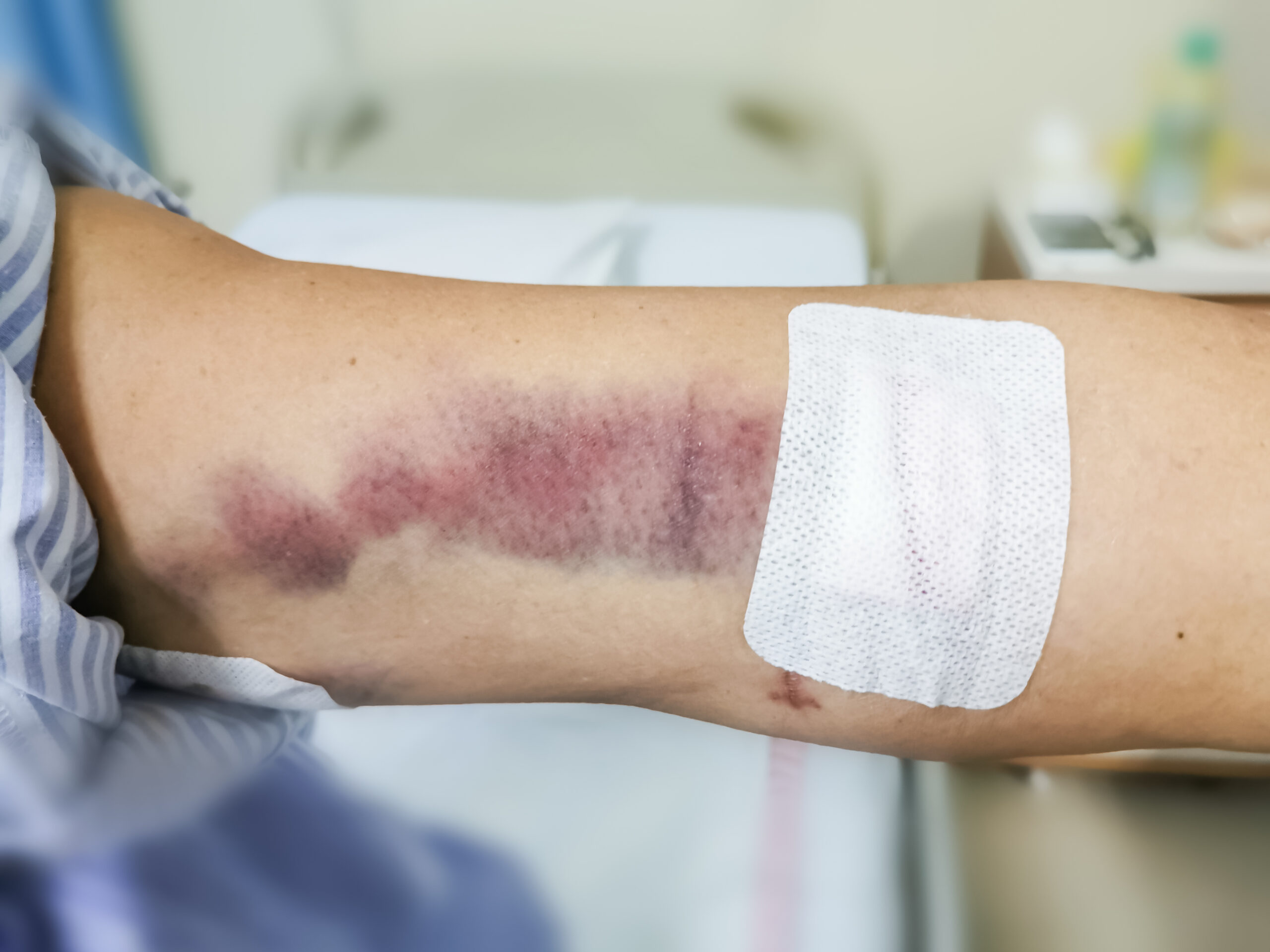 burn wound on arm