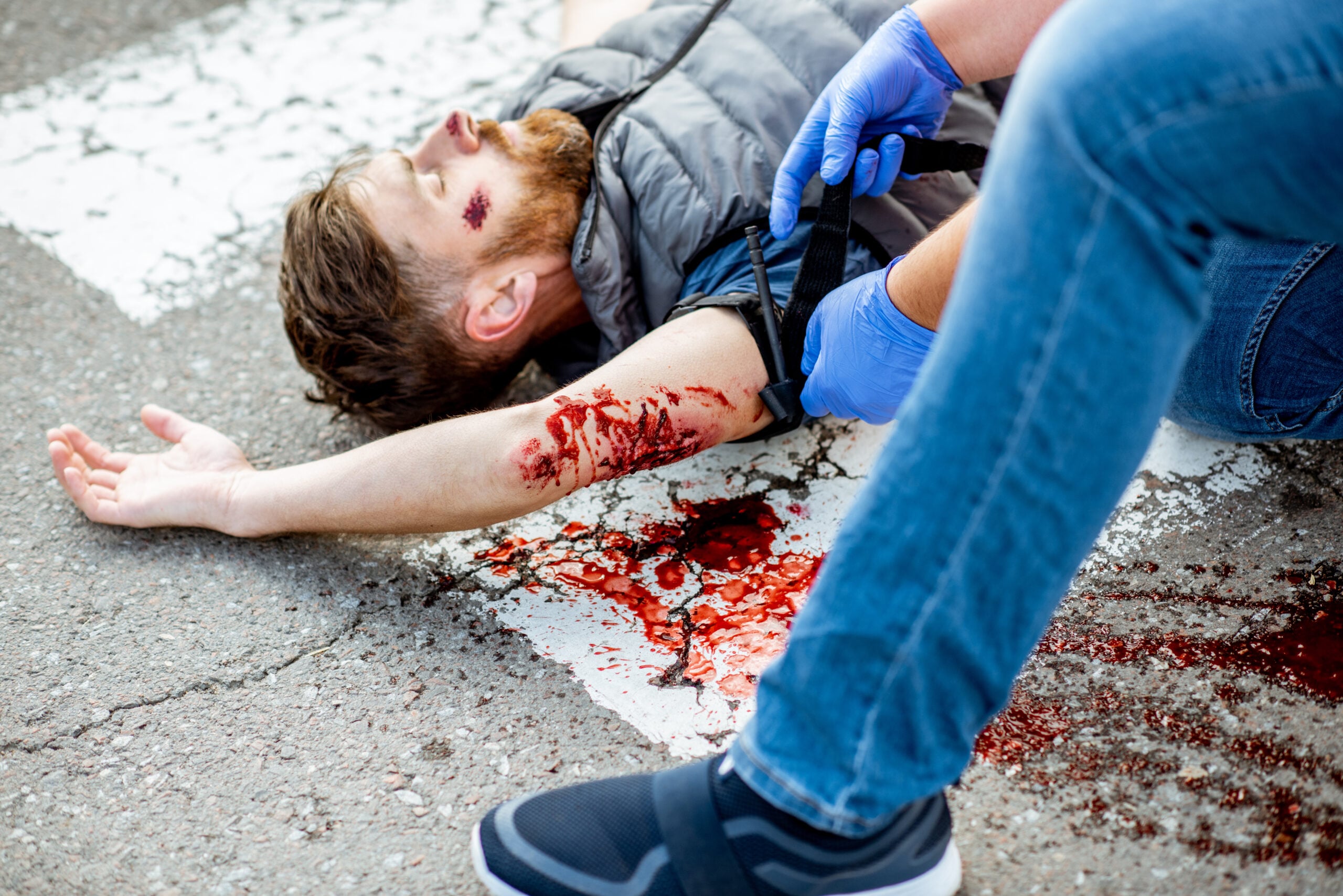 Applying first aid to the injured bleeding man, wearing tourniquet on the arm after the road accident on the pedestrian crossing