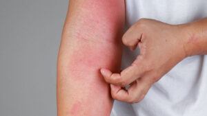 Skin Allergies man scratching red rash on arm