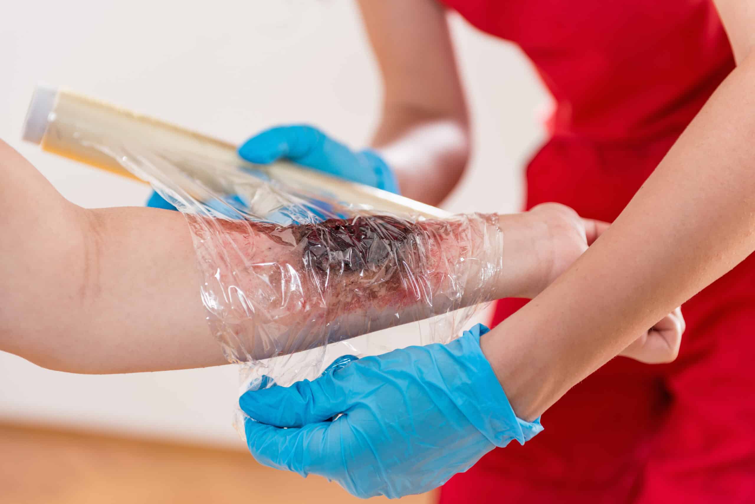 wrapping first aid for burns