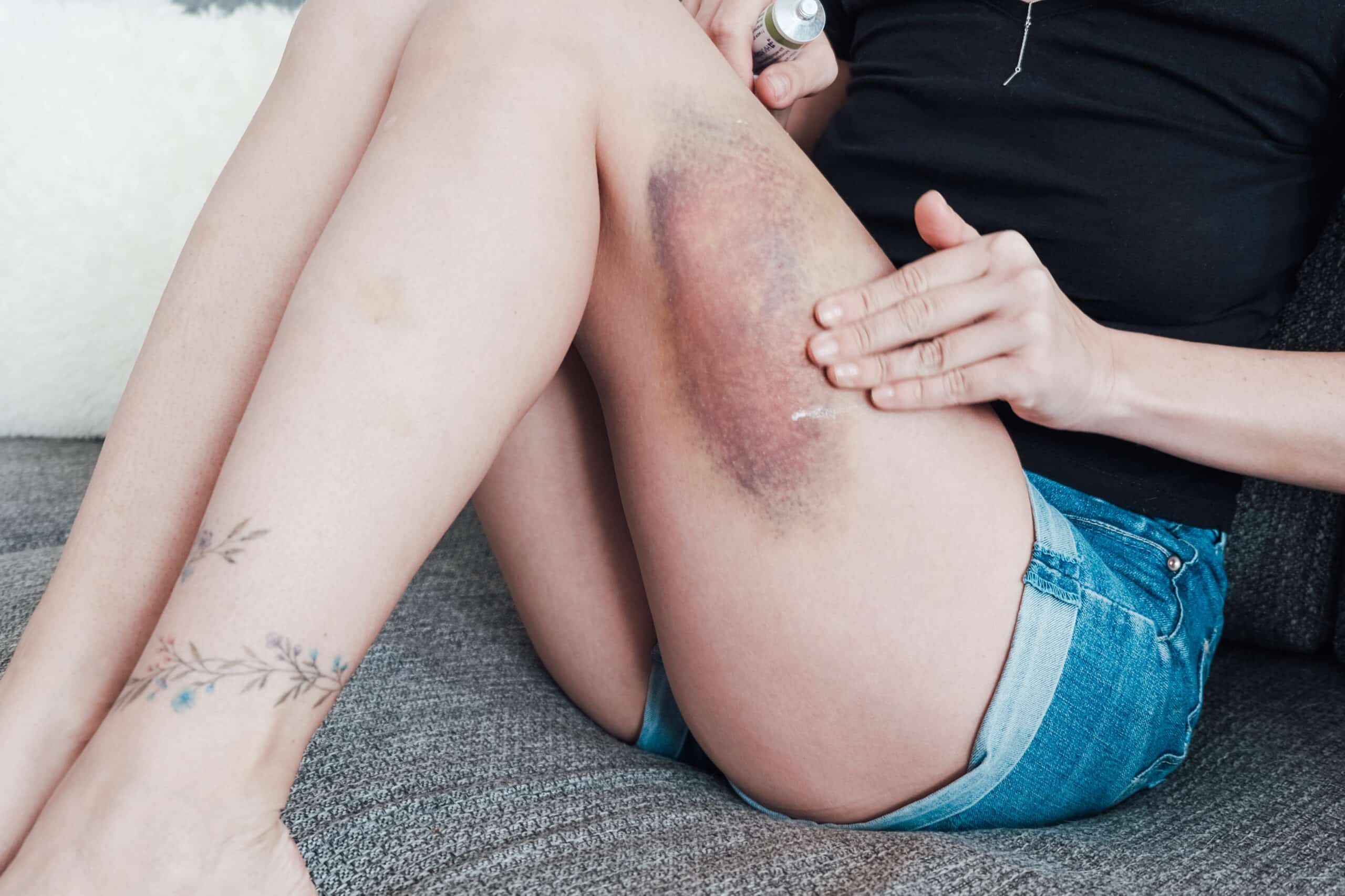 A young woman smears a large bruise on her thigh with ointment. High quality photo