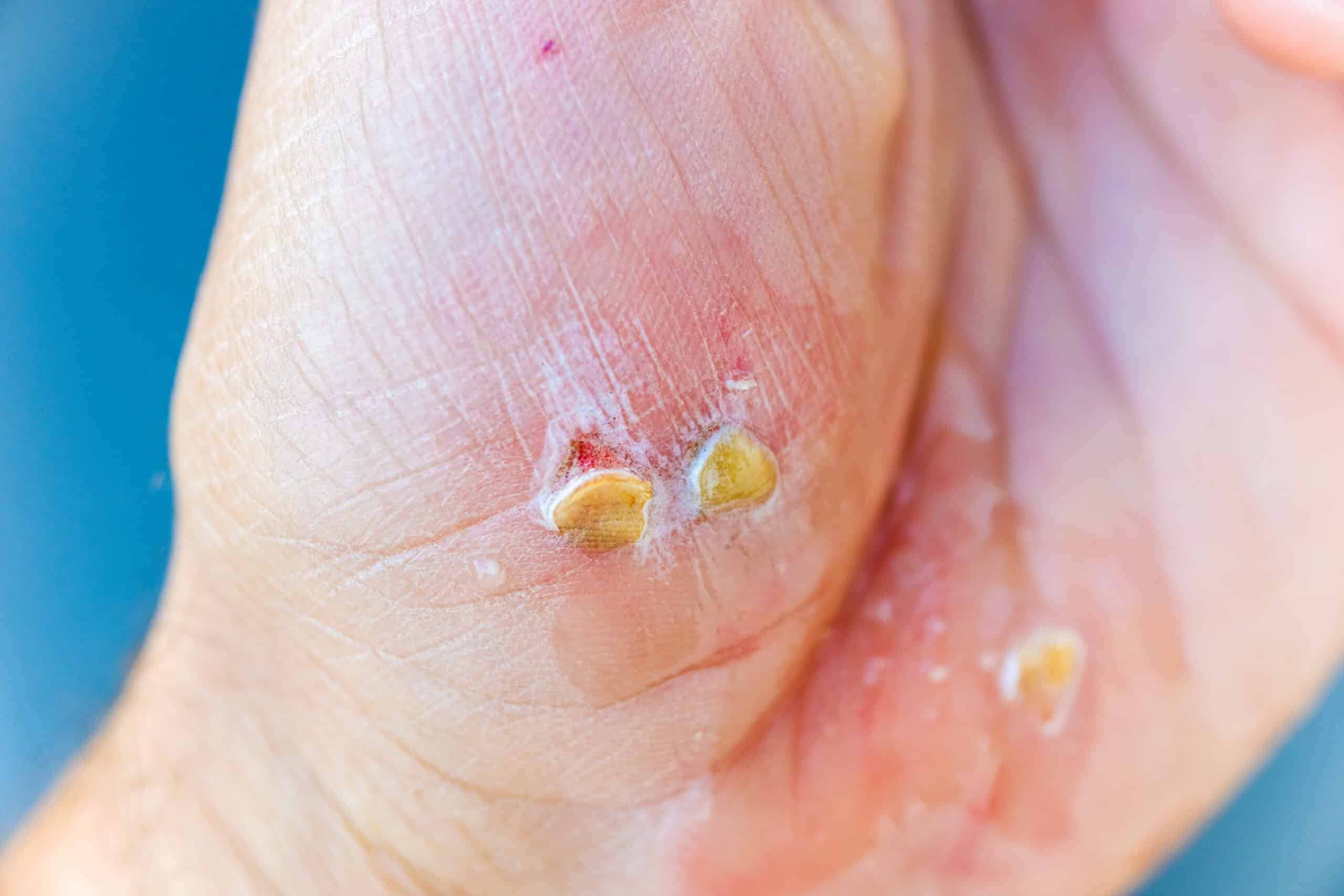 Cut wounds on one hand, bleeding, with white bubbles from the hydrogen peroxide to heal it.