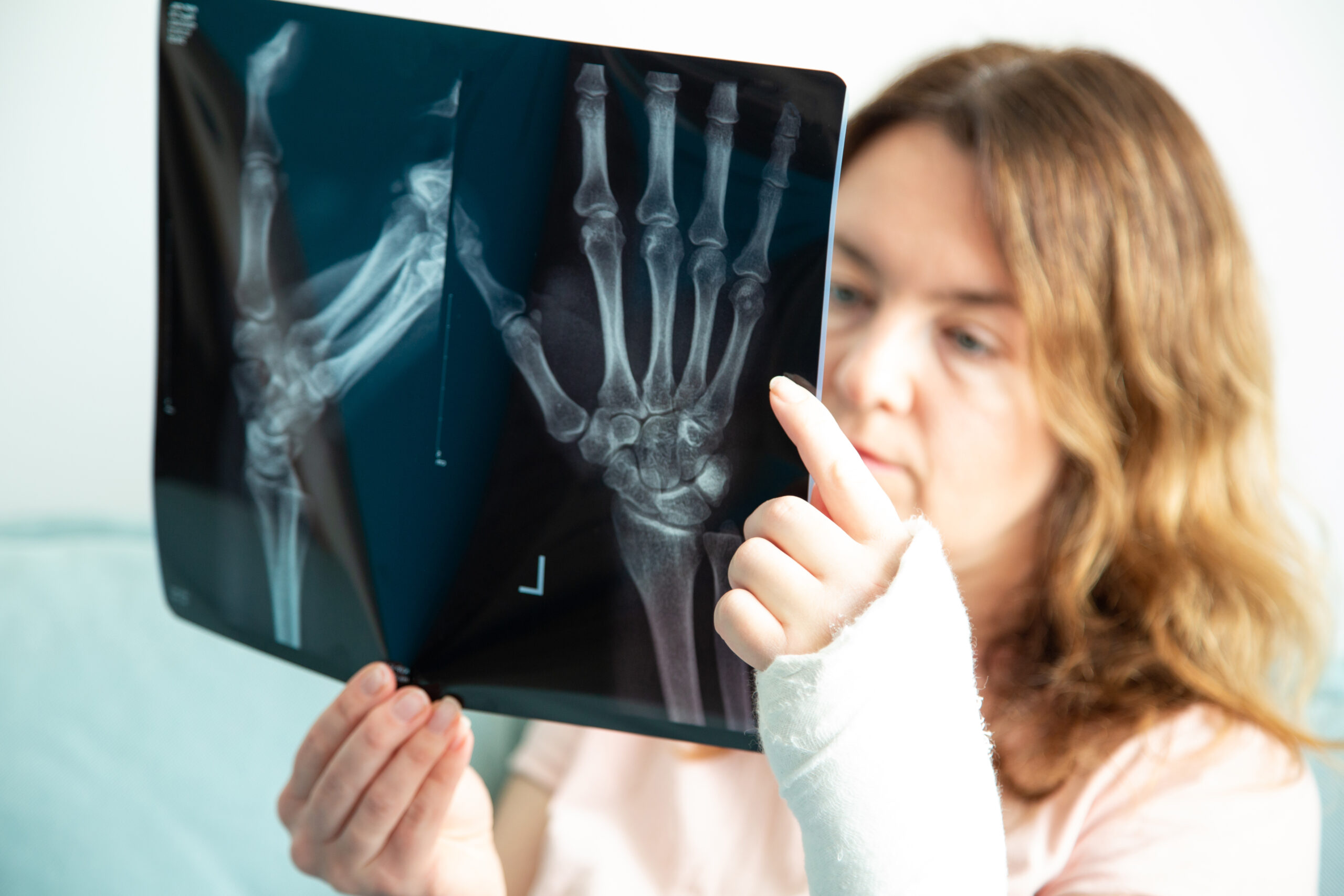 Comminuted Fracture