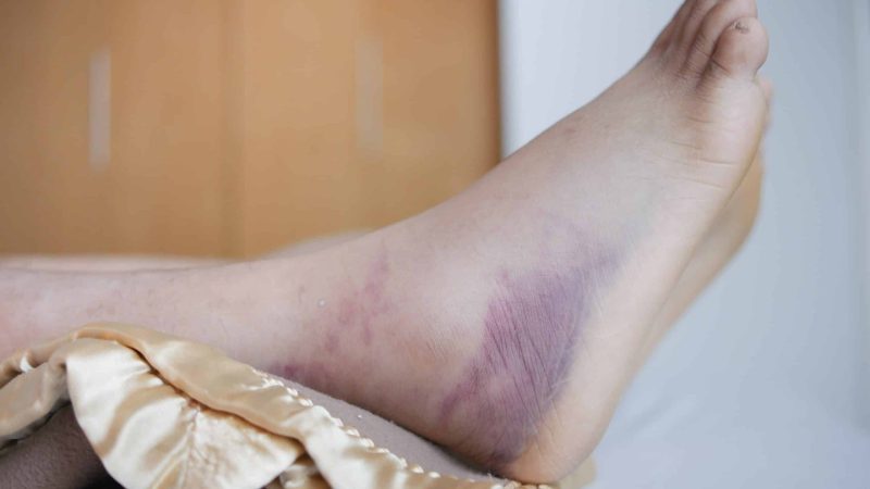 How to Treat a Sprain 2024 RICER
