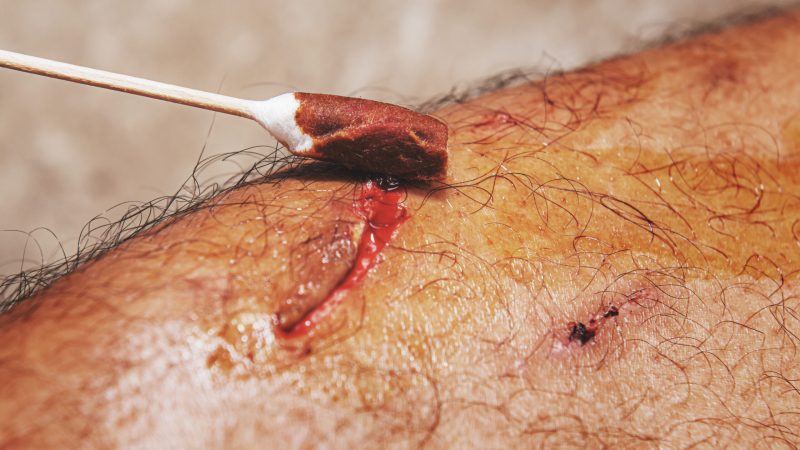 man injured. Close-up wound on leg.health care concept tetanus