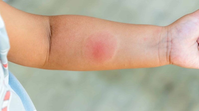first aid for a spider bite
