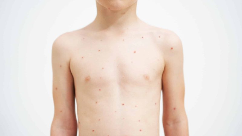 is shingles contagious? boy with chicken pox